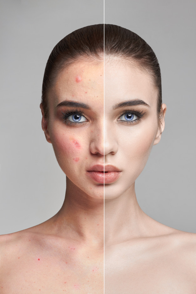 Best Acne Scar Removal Center Skin Care Treatment Clinic in Dubai