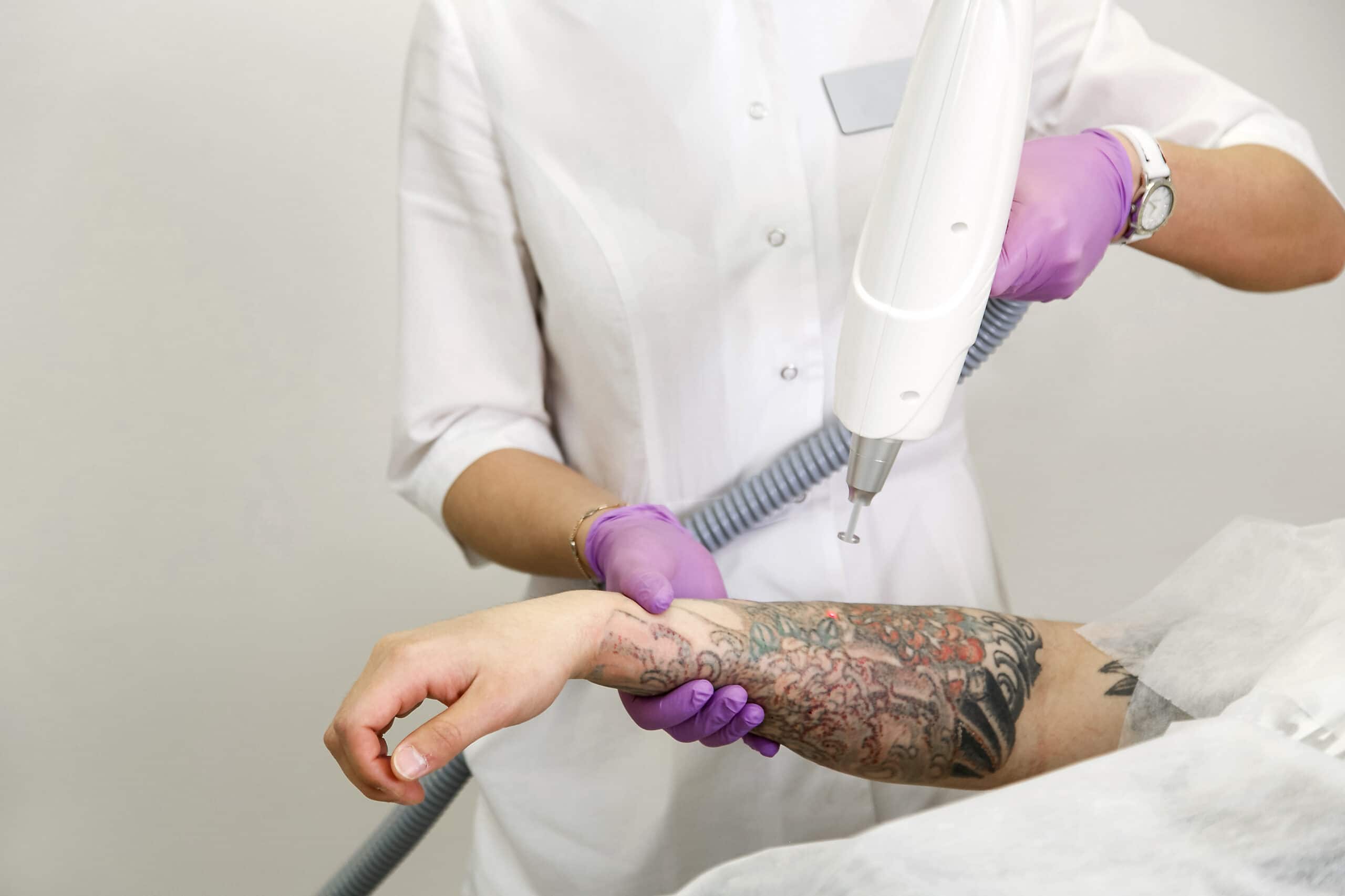 Safe & Best Laser Tattoo Removal Clinic
