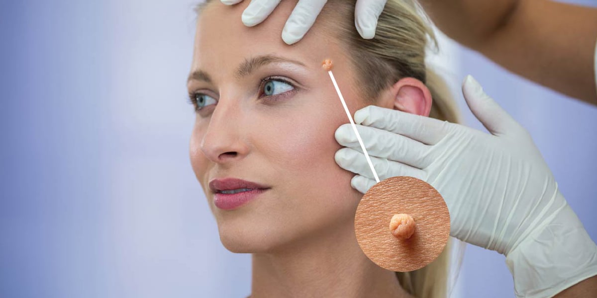Laser Skin Tag Removal Treatment in Dubai