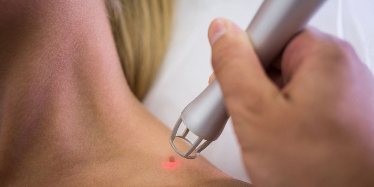 Laser Birthmarks Removal Treatment in Dubai