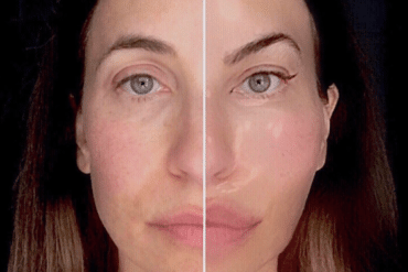 Glycolic acid peel for post inflammatory hyperpigmentation