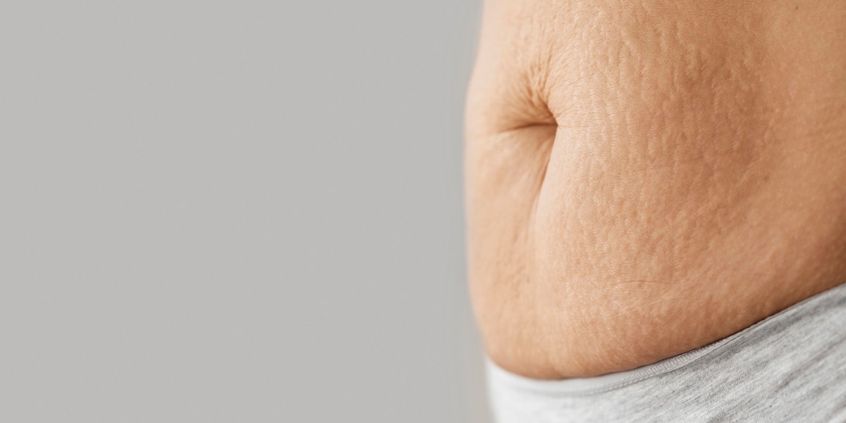 Laser Stretch Marks Removal in Dubai Best Skin Care Clinic in UAE