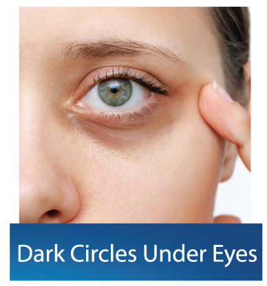 Dark-Circle-Under-Eyes
