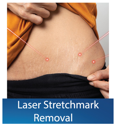 Laser-Stretchmark-removal