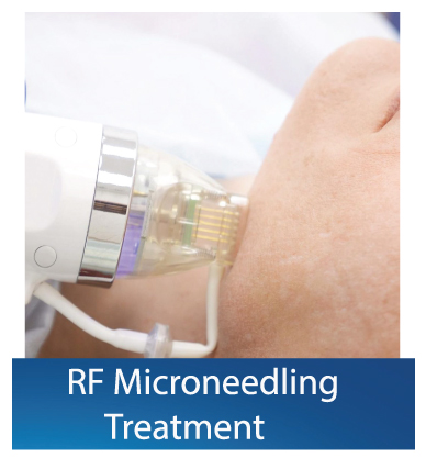 RF Microneedling treatment Dubai