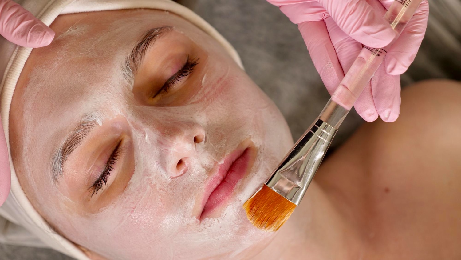 Glycolic Acid Peel for Hyperpigmentation