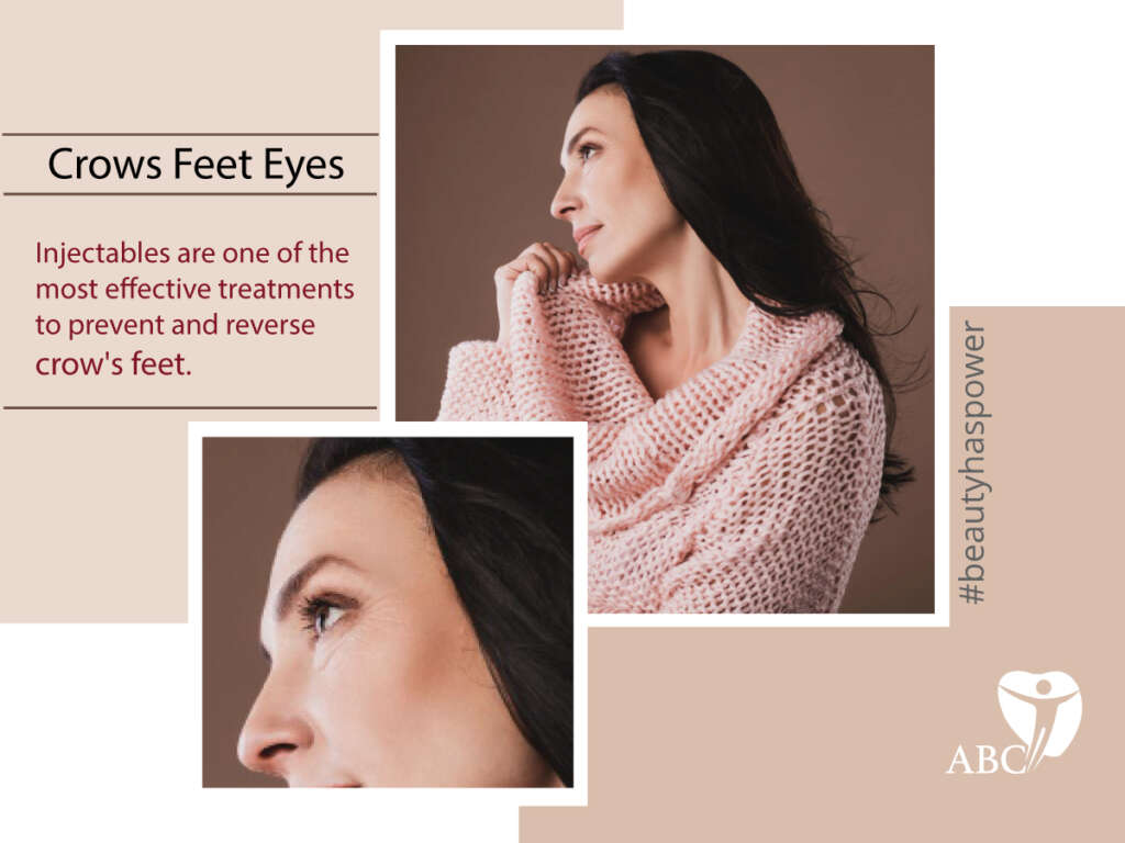 Botox For Crow’s Feet Eyes |  Aesthetic Injection Treatment