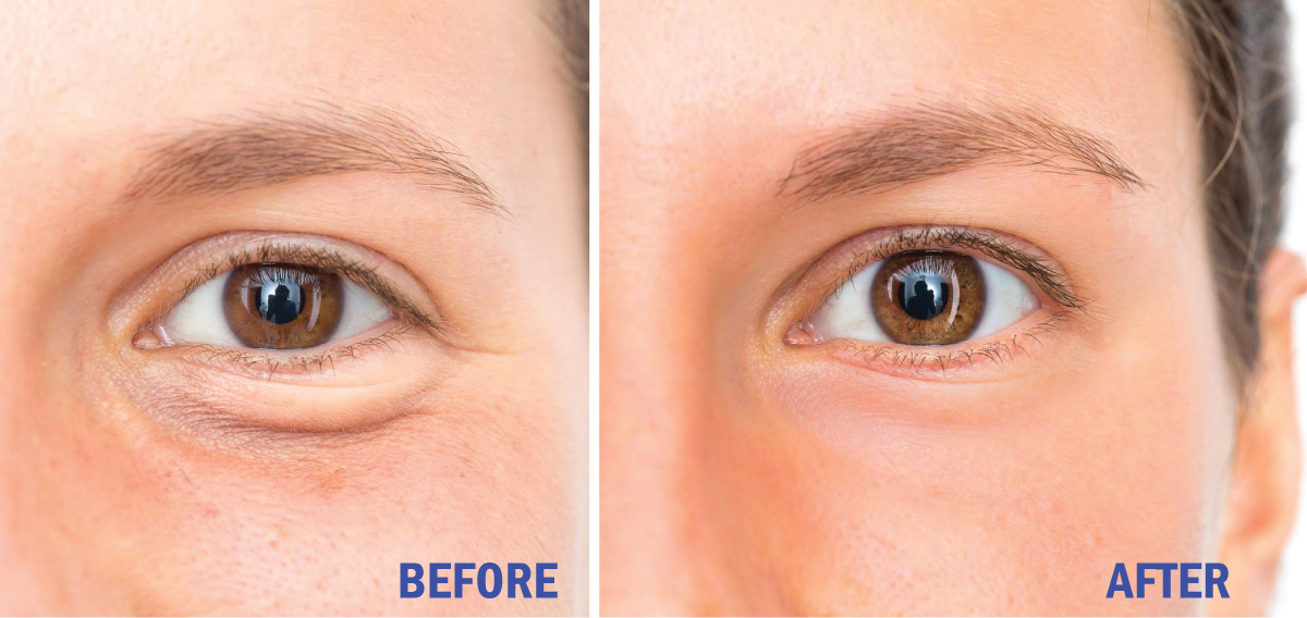 Bags-under-eye-before-and-after