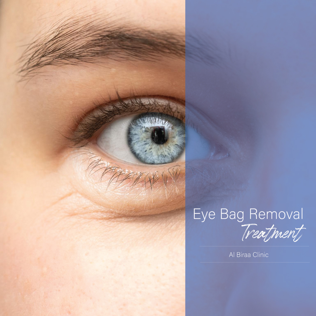 Eye-bag-removal-treatment-in-Dubai