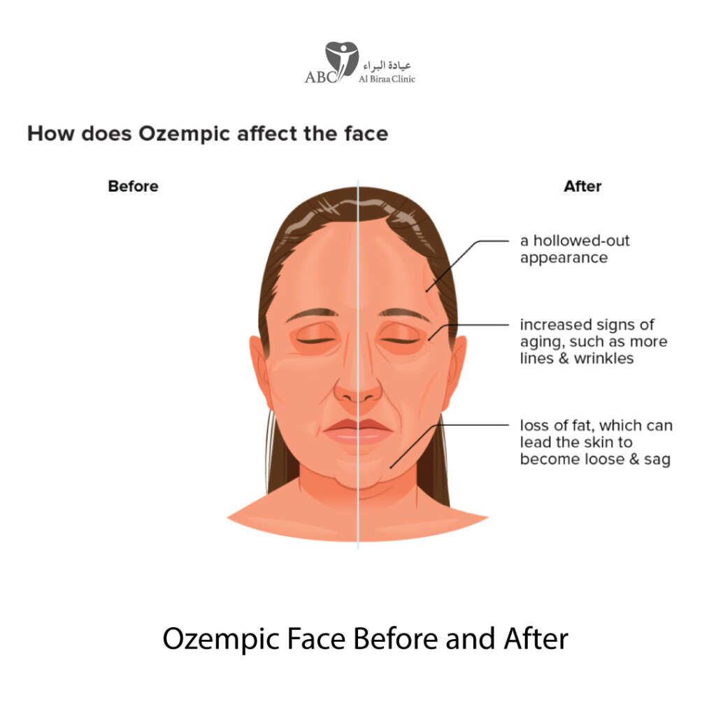 Ozempic Face Before and After Picture for Reference in Dubai