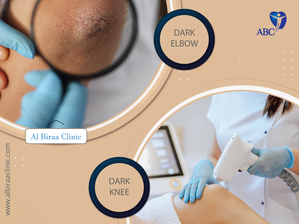 Elbow and Knee Whitening treatment Dubai