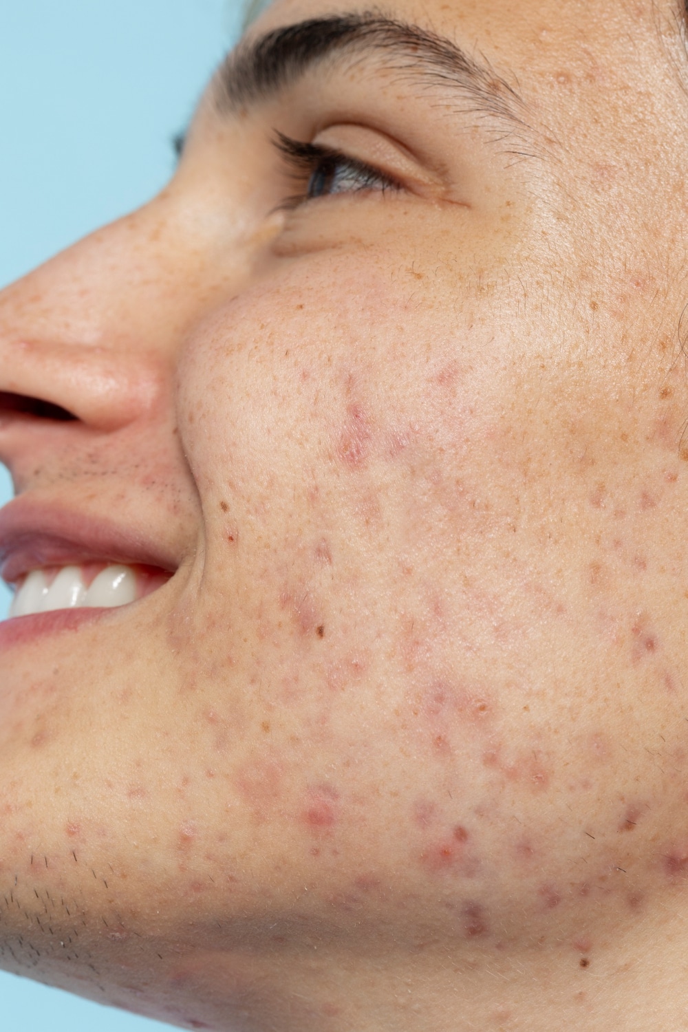 Large Pores Treatment- Aesthetic Clinic