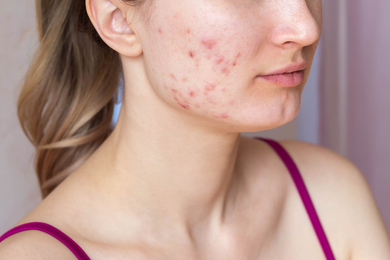 Best Acne Treatment Dubai