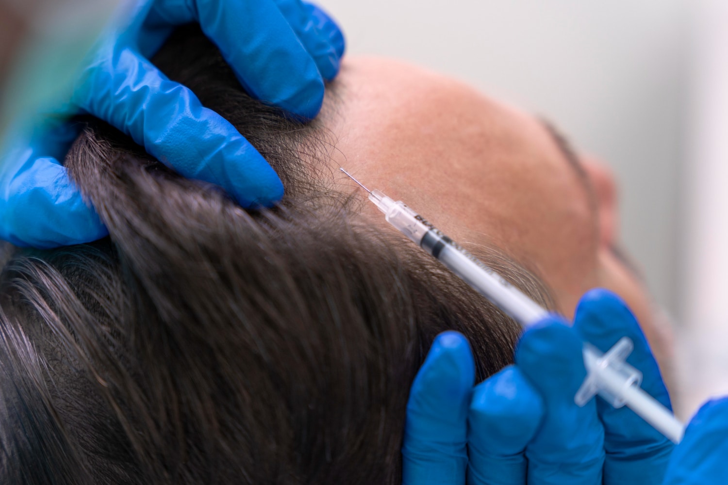 Mesotherapy for MEN