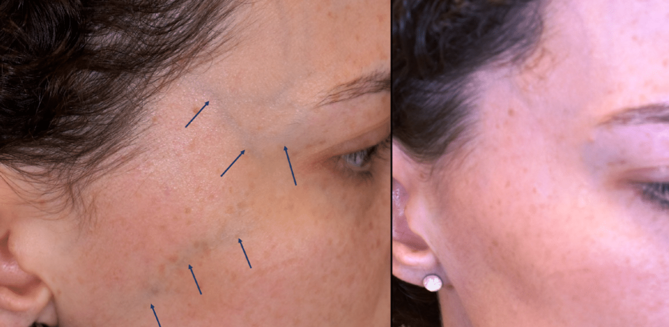 Before After Spider Vein Treatment Dubai