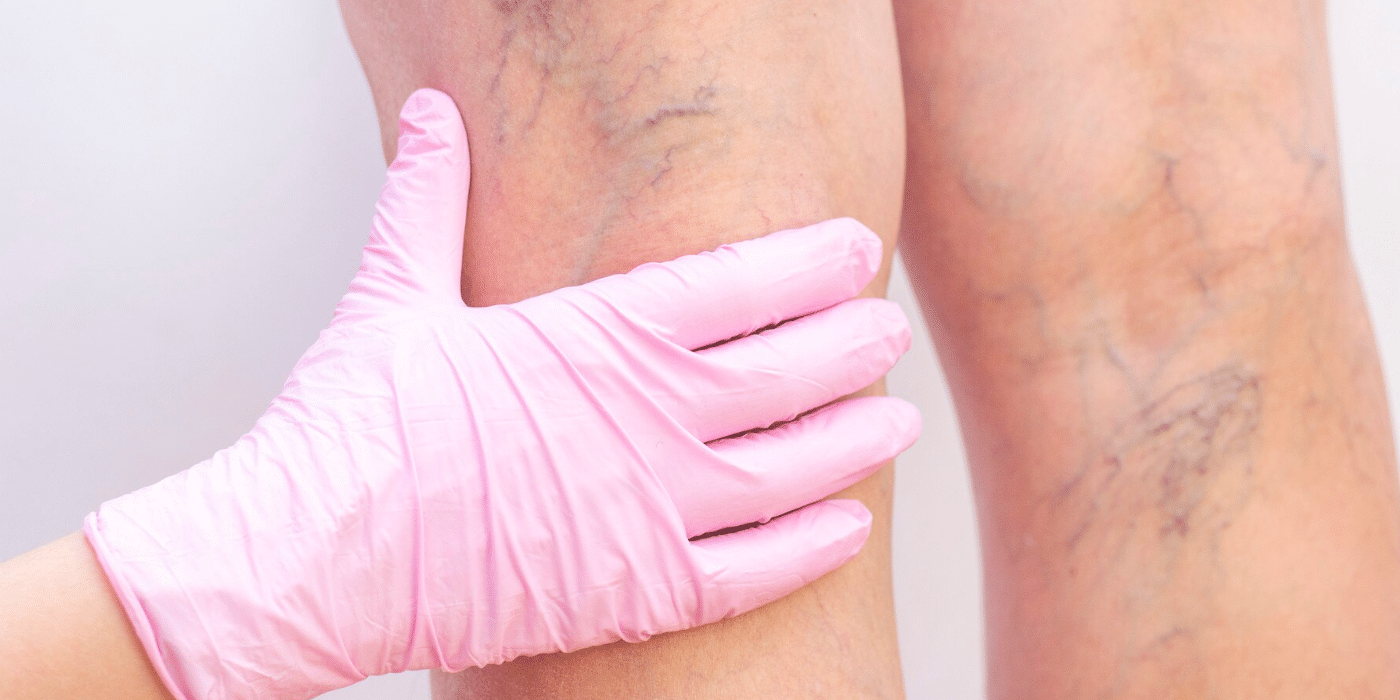 Best Laser Spider Veins Treatment Dubai