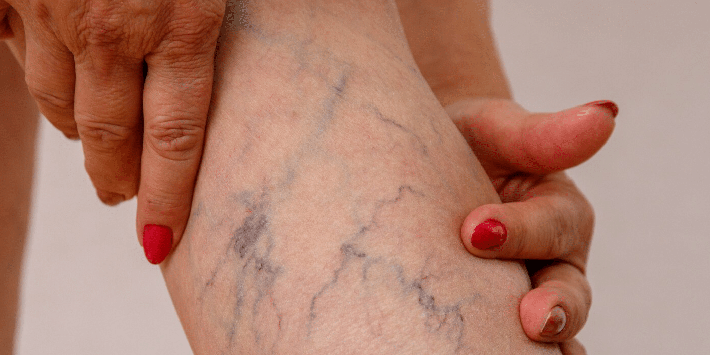 Laser Spider Veins Treatment -MEN