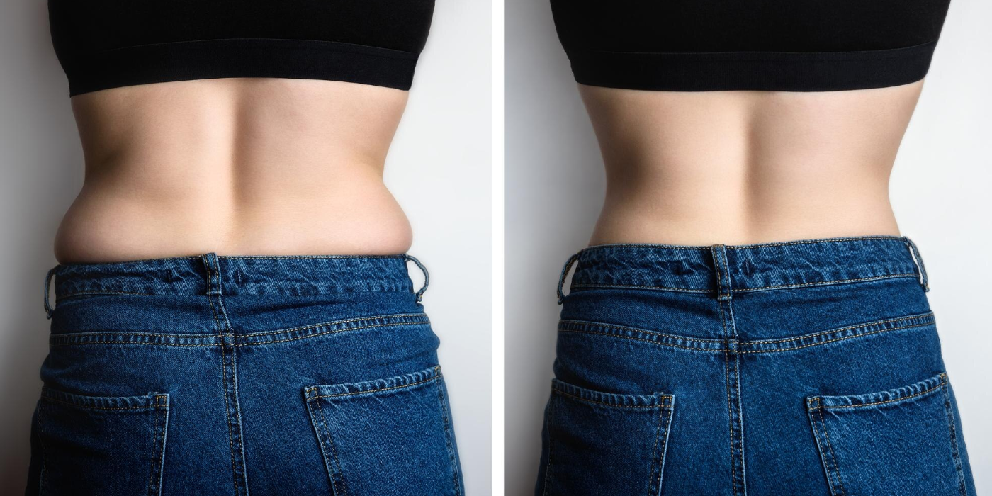 Mounjaro Weight Loss - Before and After