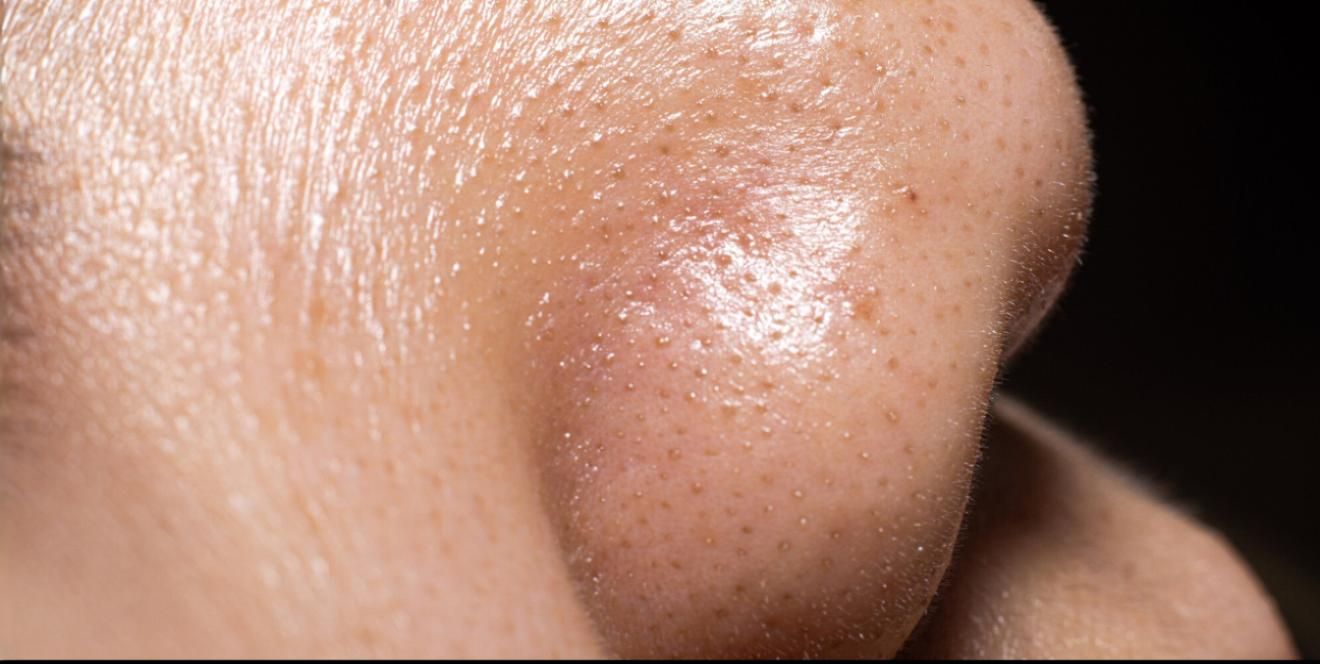 Whiteheads & Blackhead Removal