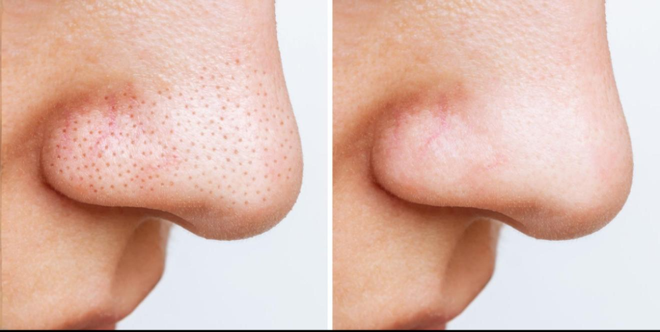 Whiteheads & Blackhead Removal - Before- After
