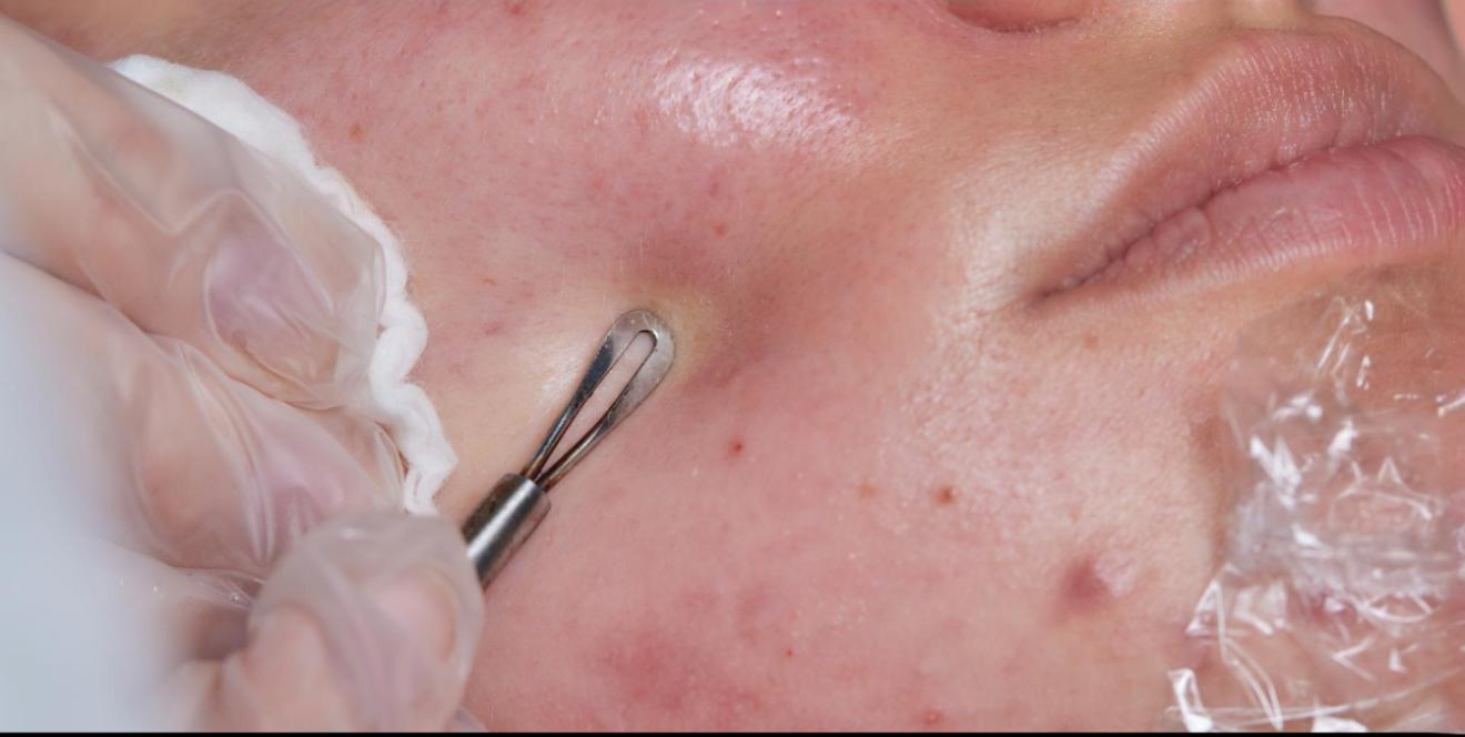 Whiteheads & Blackhead Removal Extraction Facial
