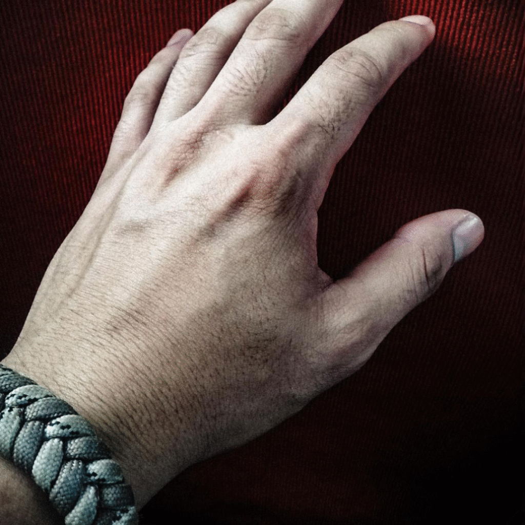 Hand Rejuvenation treatment MEN