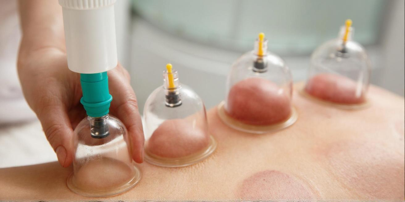 Hijama Cupping Therapy Dubai