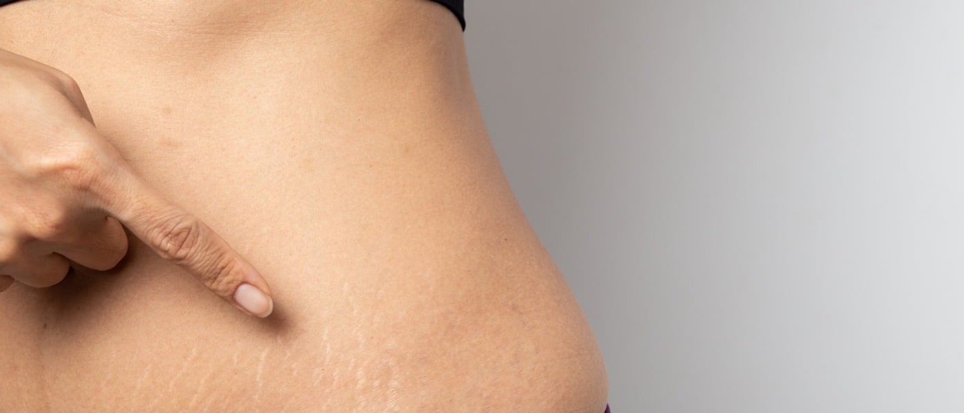 Best-Stretchmark-removal-treatment-Dubai