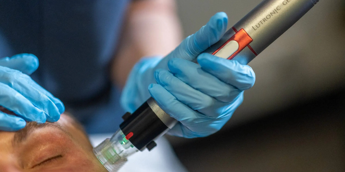 Lutronic-Genius-RF-Microneedling-For-Men