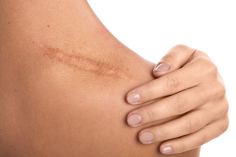 surgical-scar-treatment-dubai
