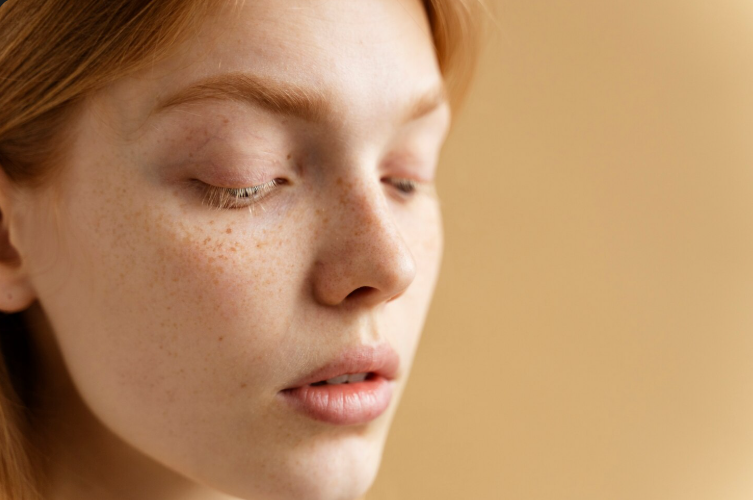 Freckles Treatment