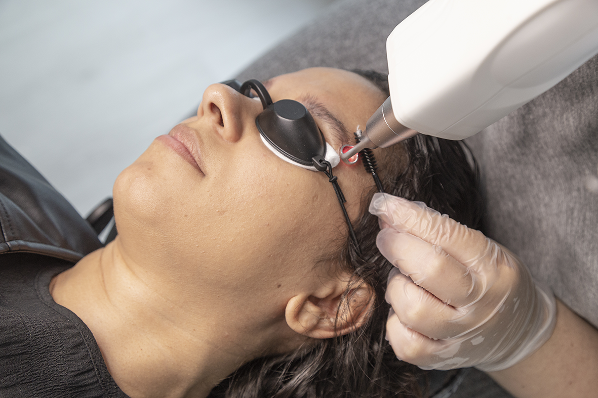 eye-brow-tattoo-removal-dubai