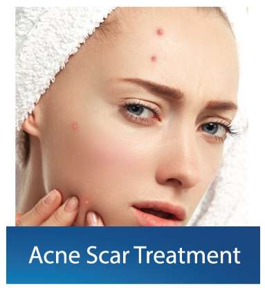 Acne-Scars treatment Dubai