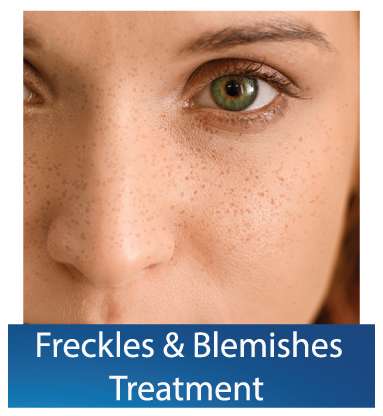 Freckles-and-Blemishes treatment Dubai