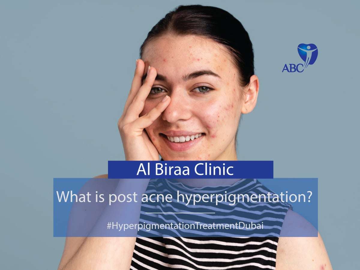 Post-Acne-hyperpigmentation