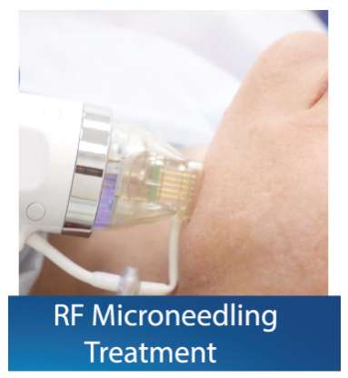 RF Microneedling treatment Dubai